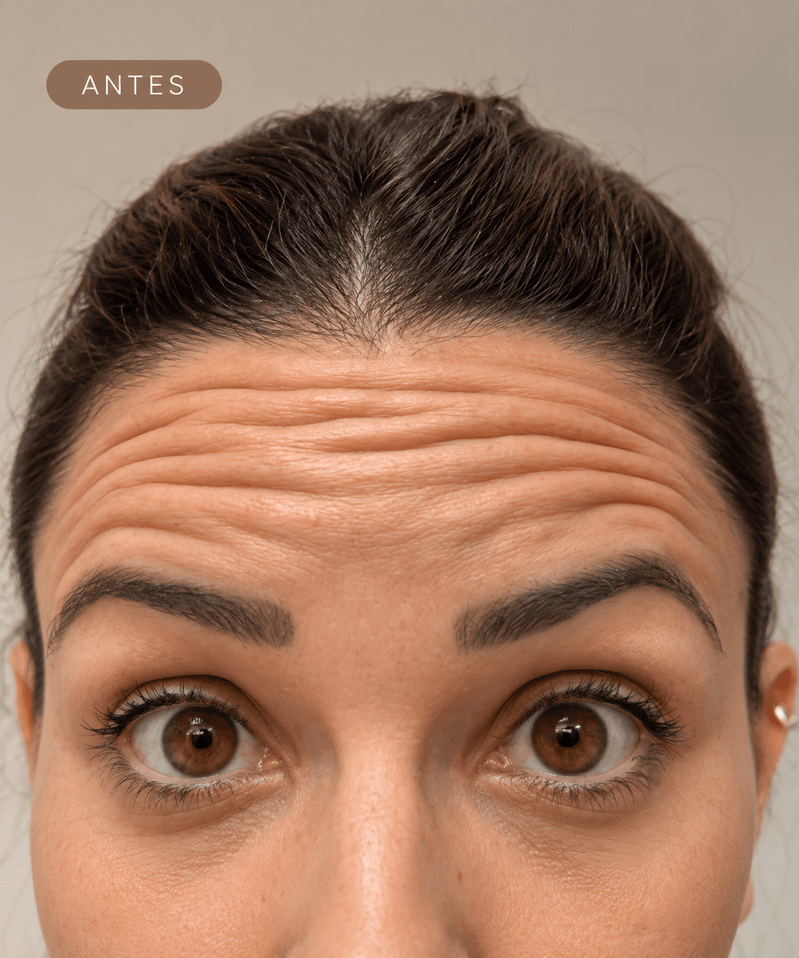 Antes — Aplicação de Botox