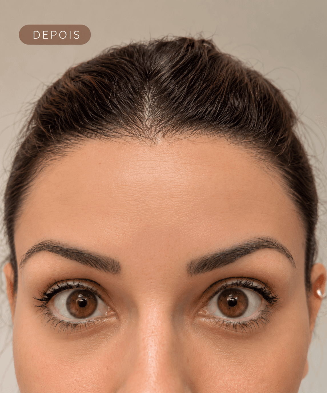 Depois — Aplicação de Botox