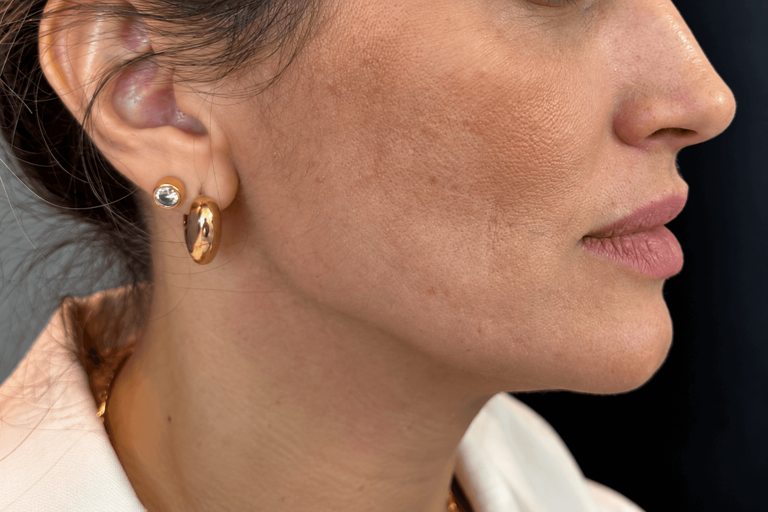 Antes — Contorno facial