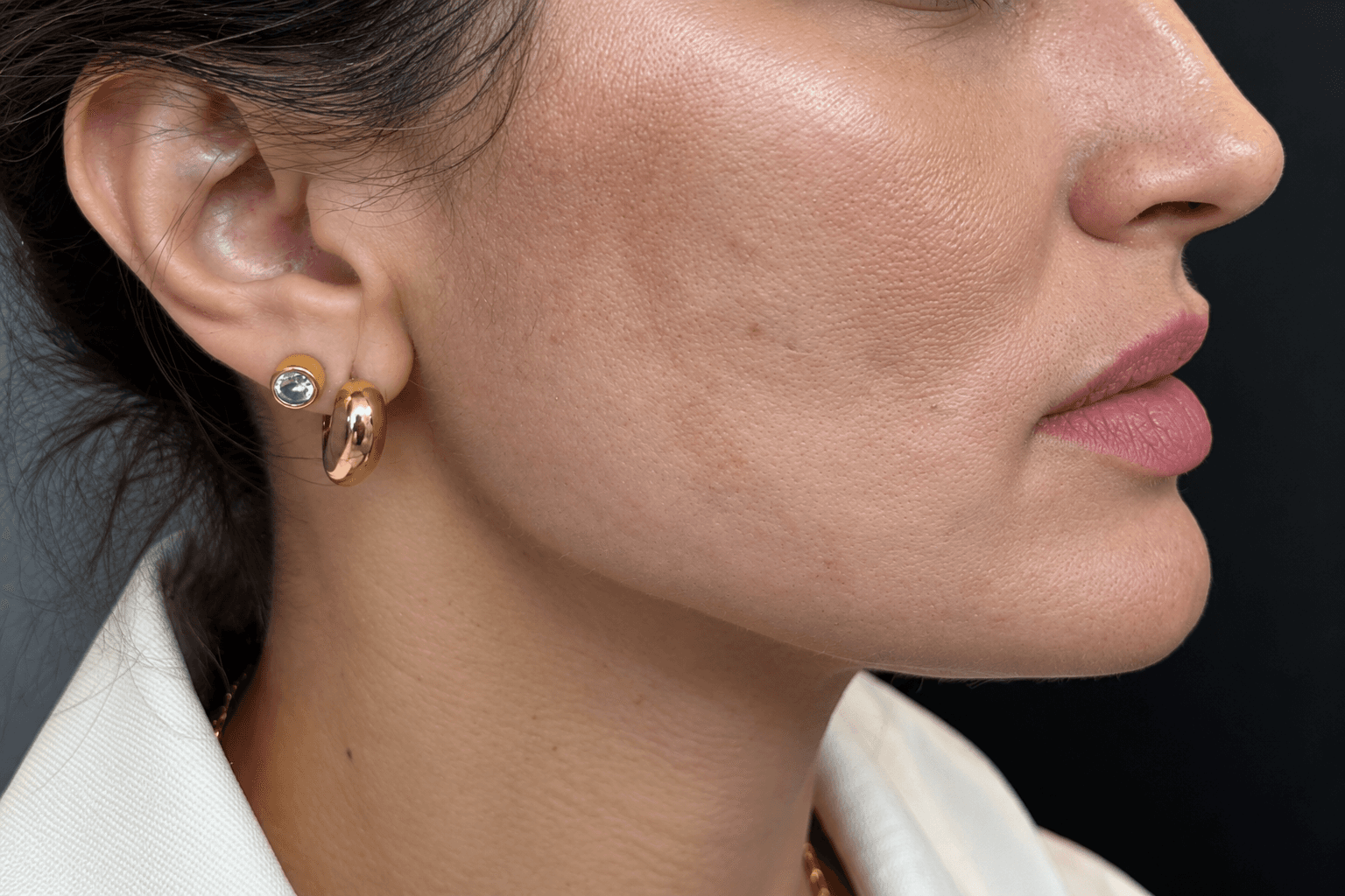 Depois — Contorno facial