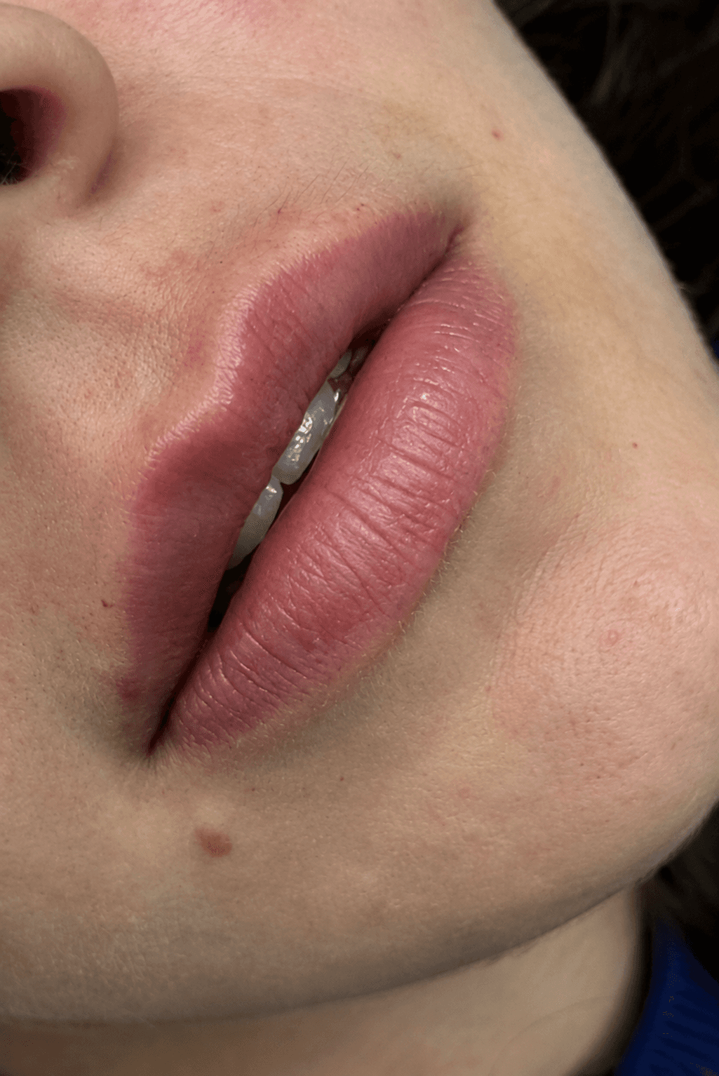 Antes — Preenchimento labial