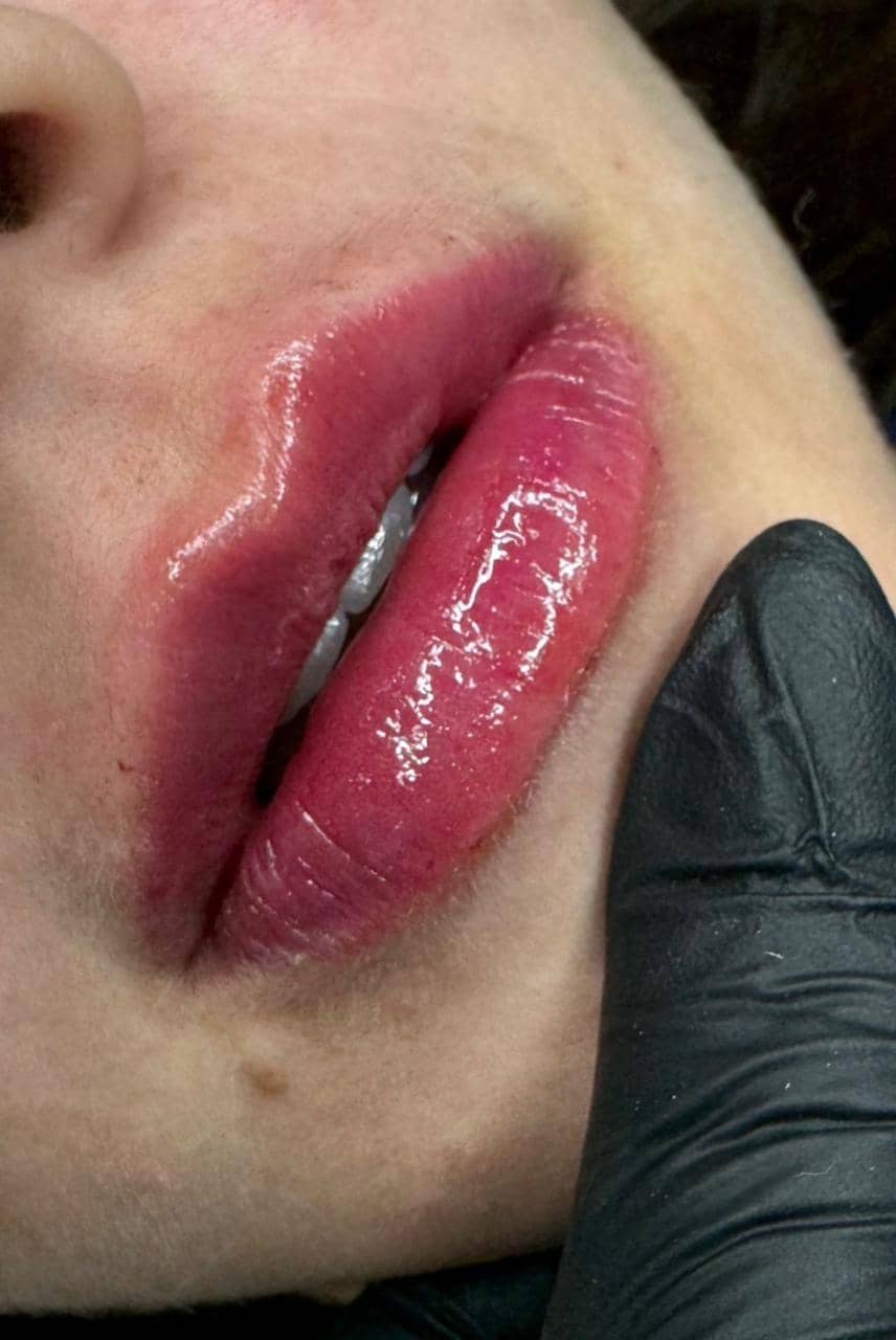 Depois — Preenchimento labial