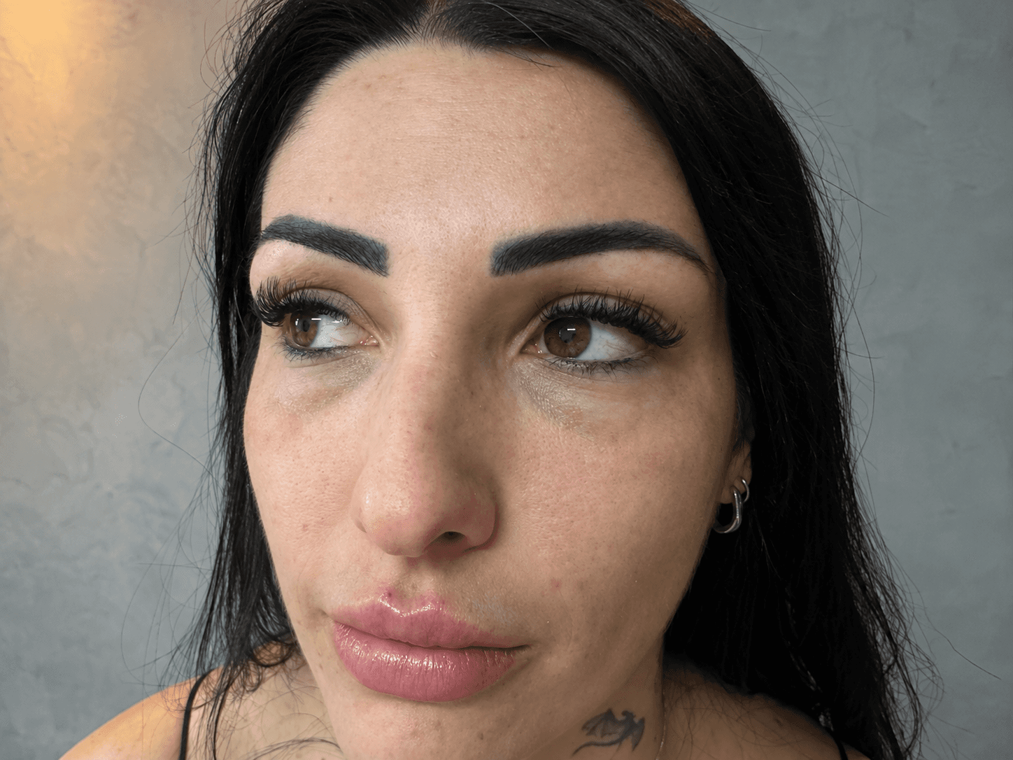 Antes — Preenchimento de olheiras